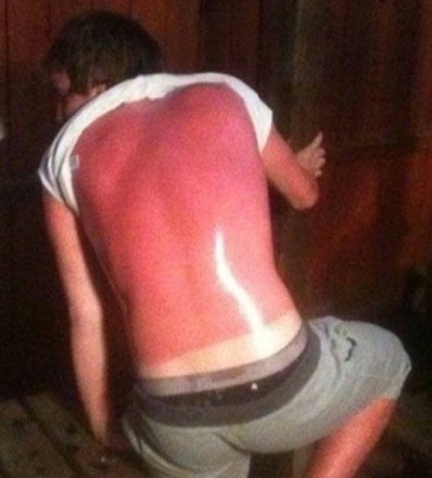 Ezért veszélyes elaludni a napon 🙁