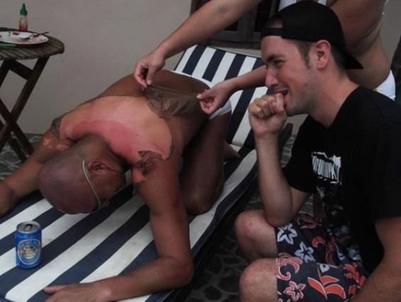 Csak óvatosan a napozással