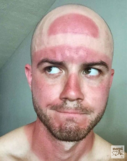 Csak óvatosan a napozással