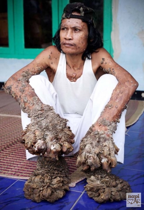 Egy ritka betegségben szenved az indonéziai faember