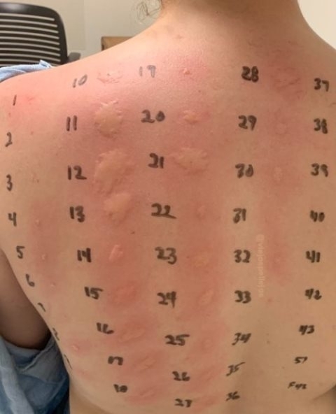 Bőrgyógyászati allergia vizsgálat