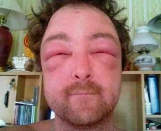 Amikor végre bejutsz a csaj combjai közé, de kijön a halallergiád