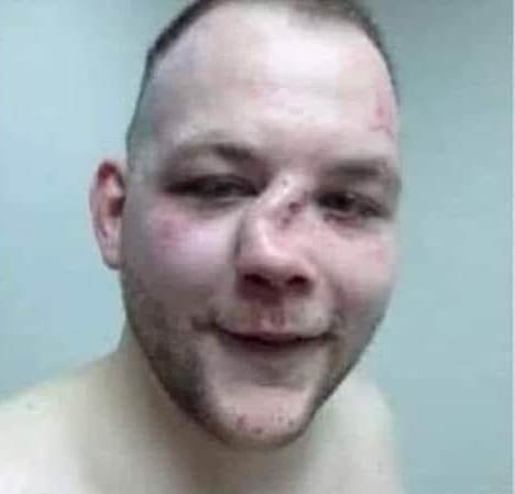 Nála már megtörtént az orra átállítása