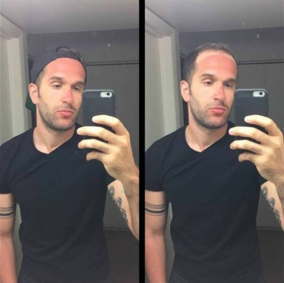 Óvatosan a napozással